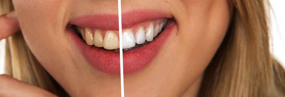 Dental sandblasting - restoring old shine and teeth whitening 