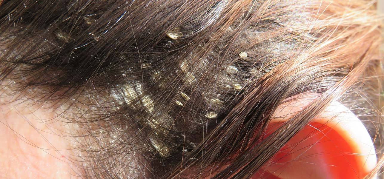 Say Goodbye To Dandruff With These Amazing Product