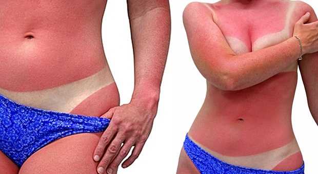 SOS Tips for Reducing Sunburn