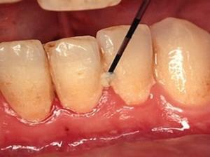  About dental biofilm